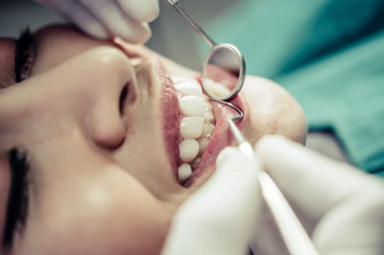 Close-up of a dentist performing a dental filling procedure with mirror and tool inside a patient's mouth