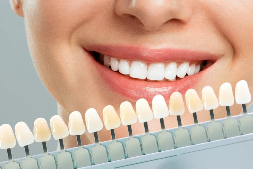 Close-up of woman’s smile with dental veneers shade guide for color matching at Fairfield Dentistry