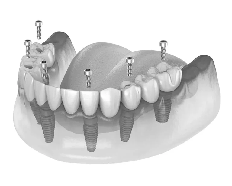 All-on-X Full Mouth Dental Implants in Fairfield | Complete Smile Restoration