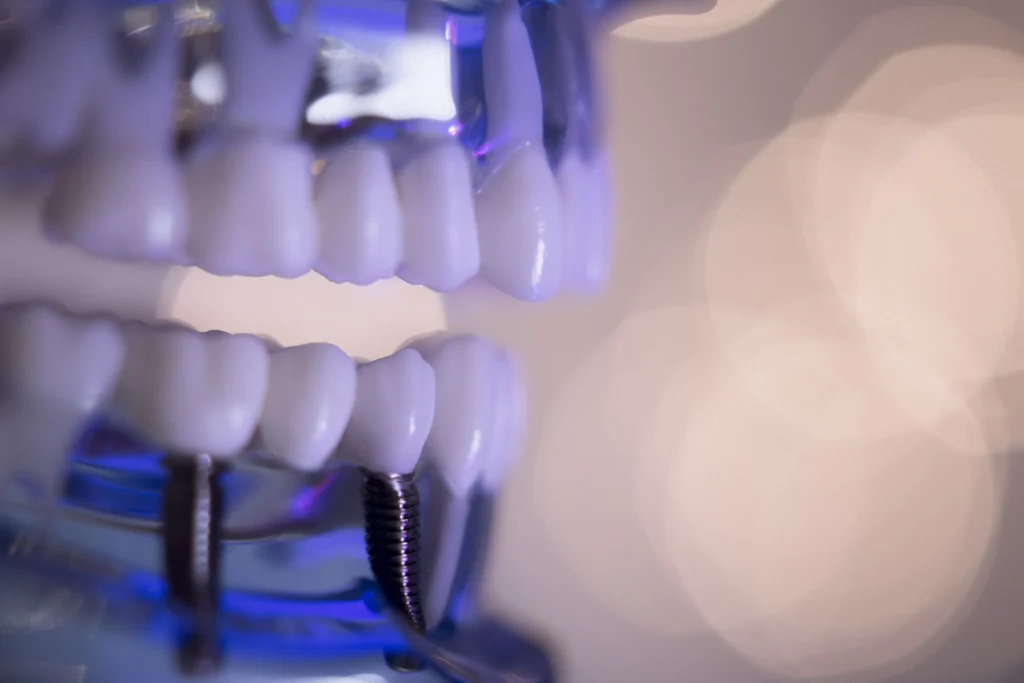 Close-up of a full mouth dental implant model showing titanium posts and artificial teeth, used to demonstrate complete smile restoration with implants