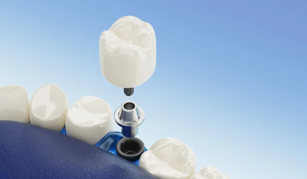 3D rendering showing the components of a dental implant, including crown, abutment, and post, used in tooth replacement treatments