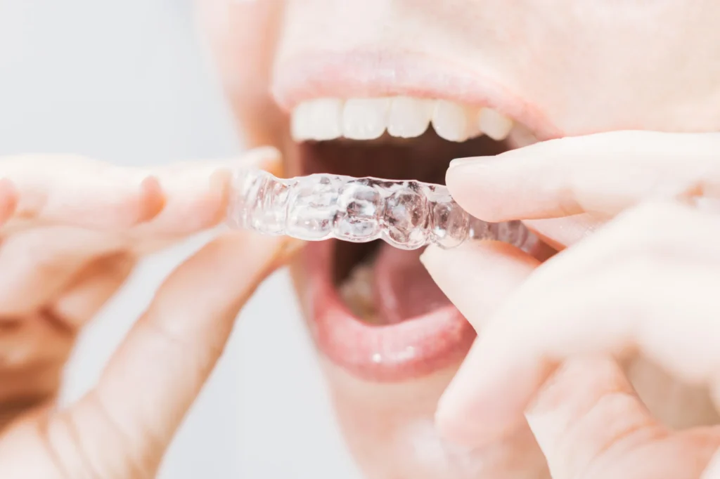 closeup-woman-s-mouth-putting-transparent-retainer-with-soft-natural-lighting