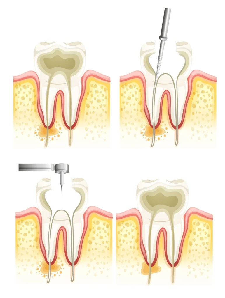 Step-by-step illustration showing the stages of a root canal treatment, from infection removal to filling the tooth