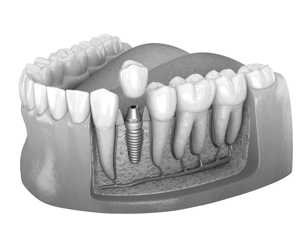 single dental implant