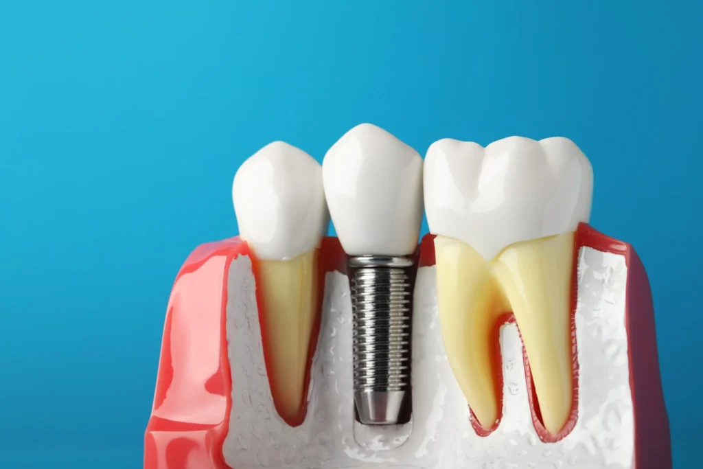 Dental Implant Healing Timeline: What Fairfield Patients Can Expect