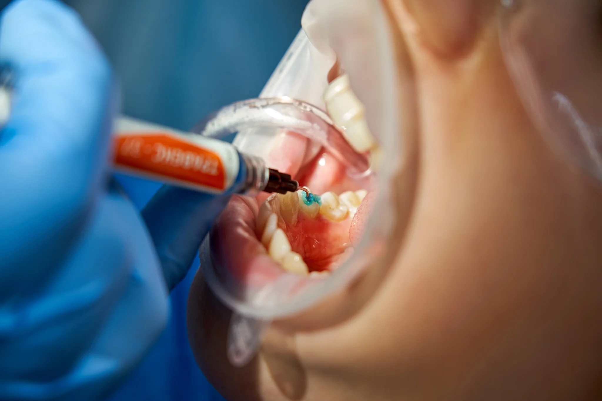 Dental Fillings in Fairfield – Types, Process & Benefits