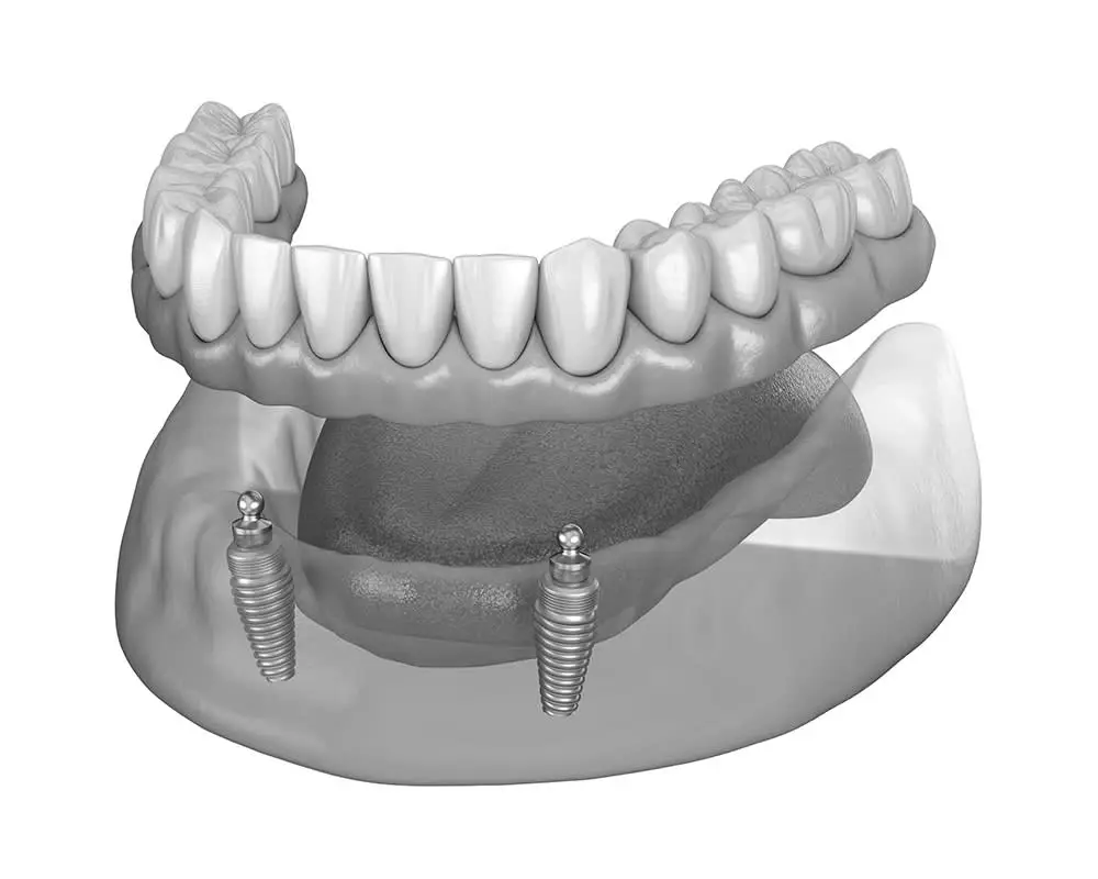 Dental Implants Full Mouth Restoration in Suisun City, CA