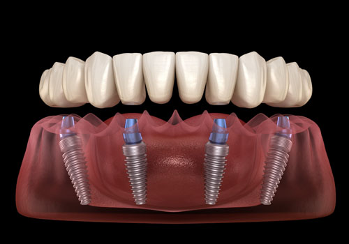 Full-Arch or All-on-4® Implants