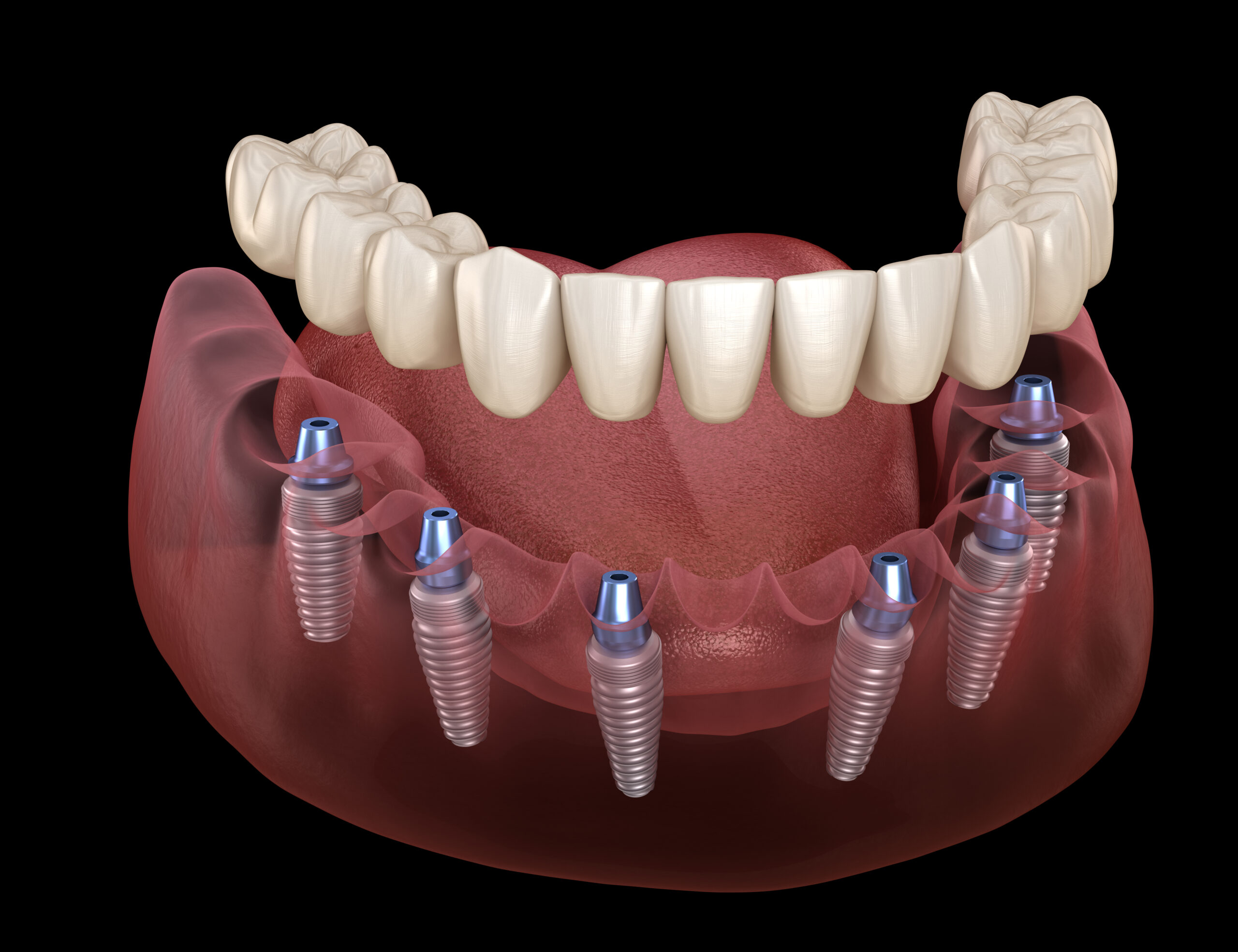 All on 6 system supported by implants. Medically accurate 3D illustration of human teeth and dentures concept