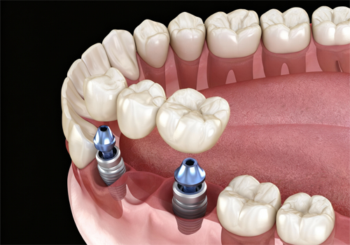 Implant-Supported Bridges