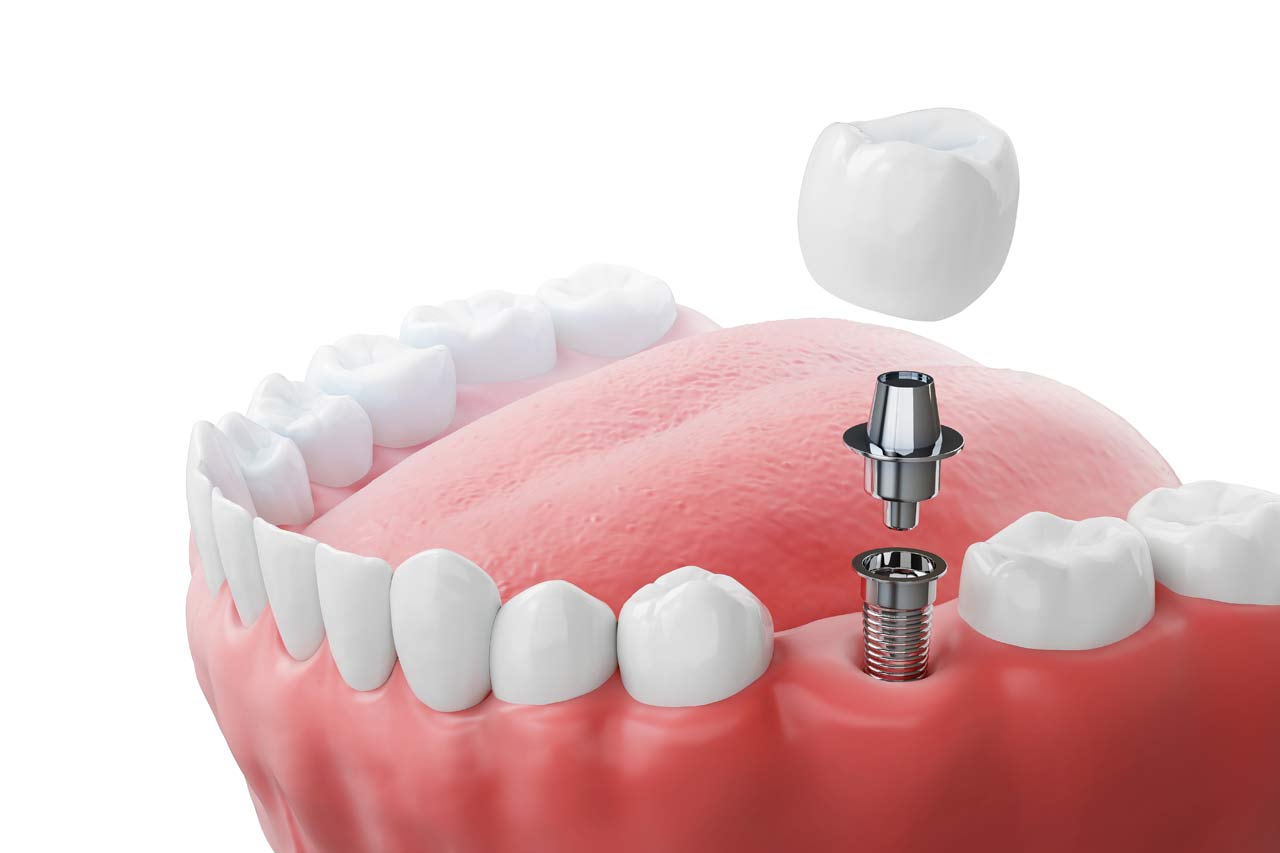 Dental Implants Fairfield