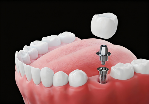 Single Tooth Implants