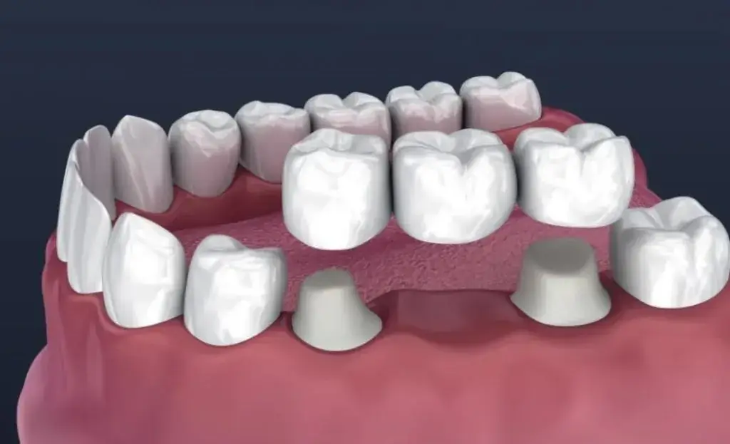 3D illustration of dental bridge showing porcelain crowns and pontic tooth replacement at Fairfield Dentistry & Implants, Fairfield CA