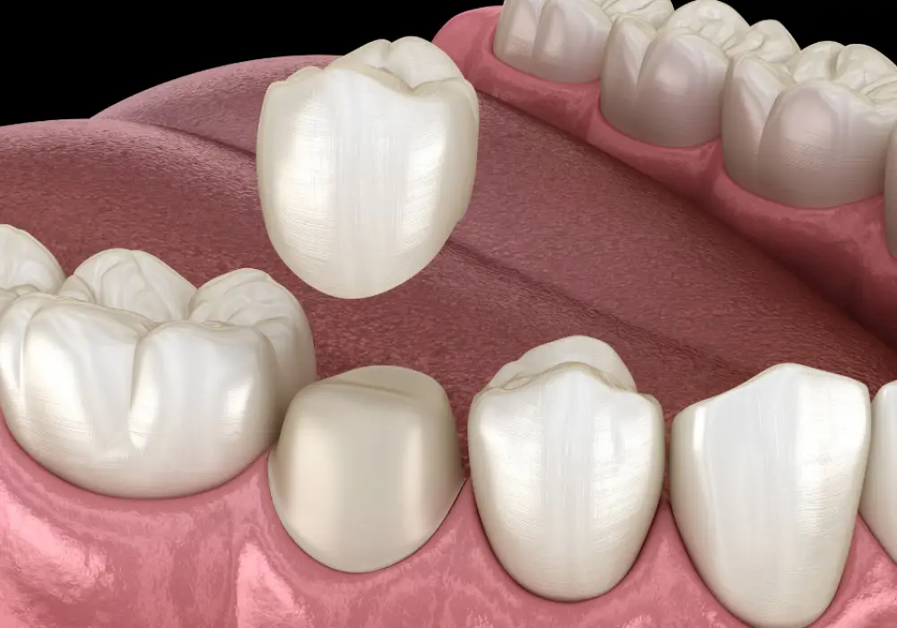 3D illustration of a porcelain dental crown being placed over prepared tooth at Fairfield Dentistry & Implants, Fairfield CA