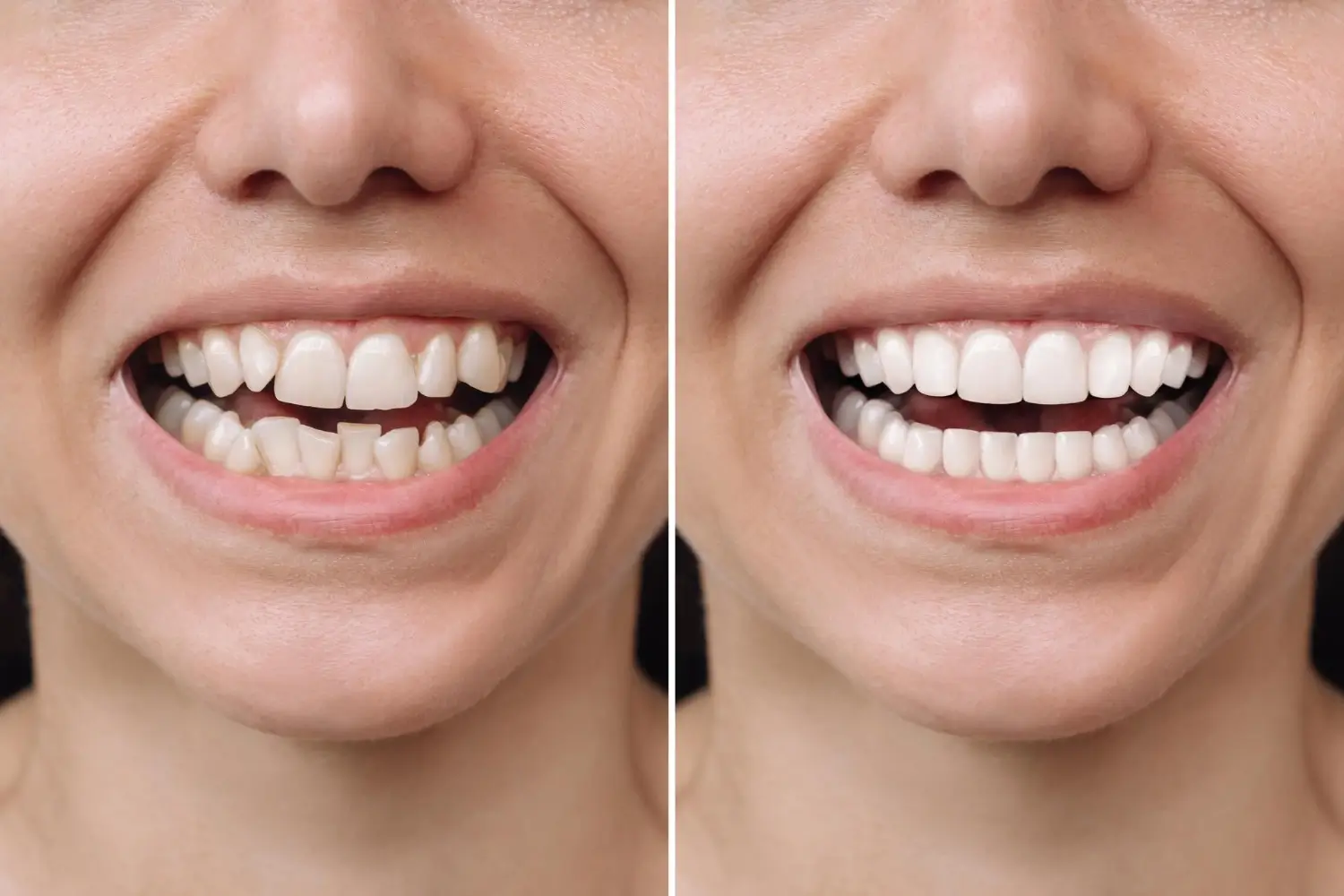 Before and after porcelain veneers smile transformation at Fairfield Dentistry in Fairfield CA